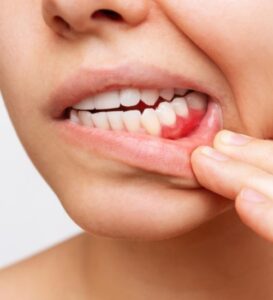 Periodontitis, bleeding gums, dentist High Wycombe