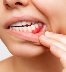 Periodontitis, bleeding gums, dentist High Wycombe