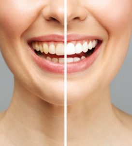 Teeth Whitening High Wycombe`