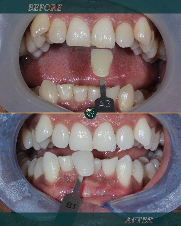 Home teeth whitening