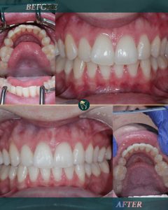 Invisalign, lower teeth clear aligners