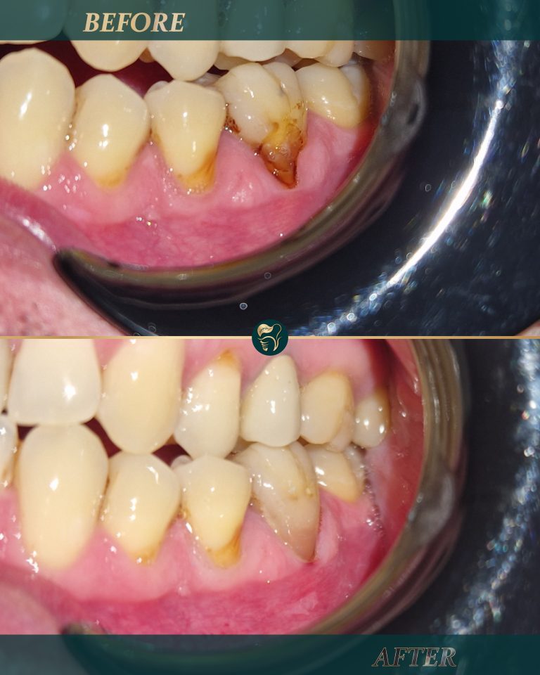 Before After Filling