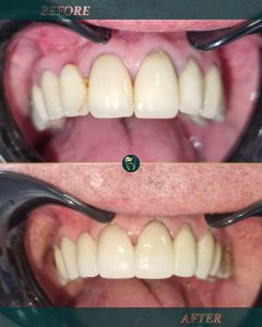 Old five teeth bridge and one single replacement