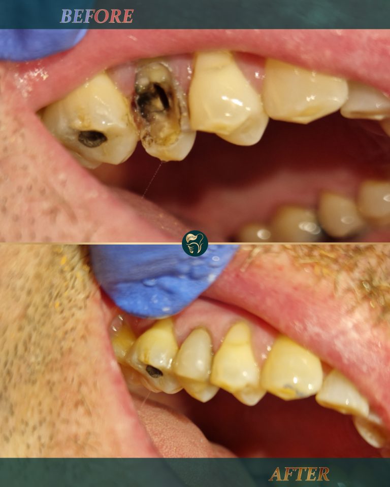 Emergency broken tooth repair