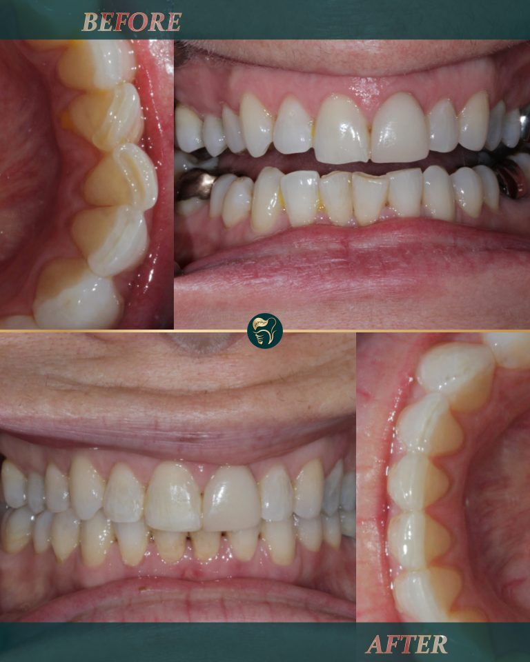 Invisalign, clear aligner